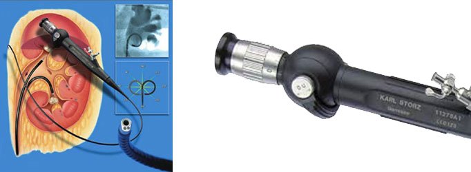 RIRS Procedure Bundle Kit